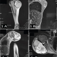 Figure 1: The magnetic resonance imaging shows a large expansile multi-loculated space occupying the lesion, abutting the spine of the scapula and encasing the glenohumeral joint posteriorly.