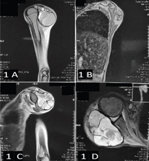 Figure 1: The magnetic resonance imaging shows a large expansile multi-loculated space occupying the lesion, abutting the spine of the scapula and encasing the glenohumeral joint posteriorly.