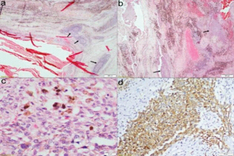 Figure 2: It shows the pathological appearance of the specimen. Hematoxylin and eosin (HE) stain section shows blood-filled cystic spaces with fibrous walls containing lymphoid follicles (arrows) and brownish pigments (a), HE ×40). In addition, there are sheets of tumor cells with infiltrating borders (black arrows) (b), HE ×100). The tumor cells have epithelioid to spindle cell morphology with vesicular nuclei, inconspicuous nucleoli, and a scant to moderate amount of eosinophilic cytoplasm. Hemosiderin deposition is present (c), HE ×400). Tumor cells are diffusely immuno positive with desmin (d), ×200).