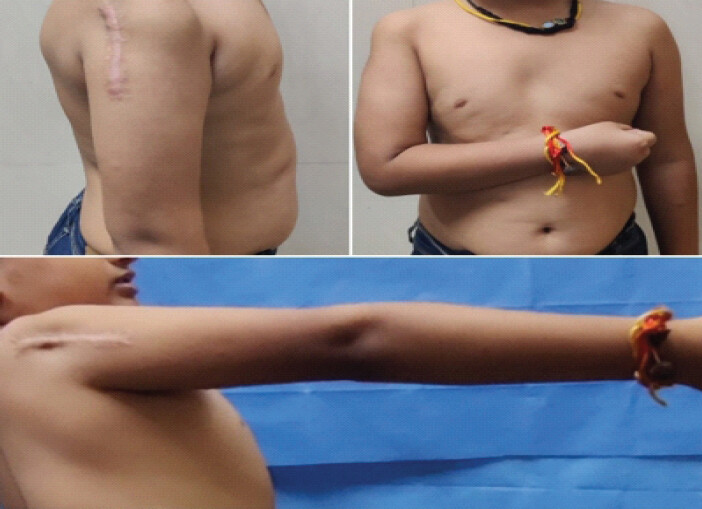 Figure 3: It depicts the moderate functional recovery of the shoulder at the 3-year follow-up.