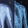 “A Giant Shoulder”: Proximal Humerus Giant Cell Tumor Managed With Extended Curettage and Proximal Humerus Internal Locking System Plating with Fibular Strut Graft – A Case Report