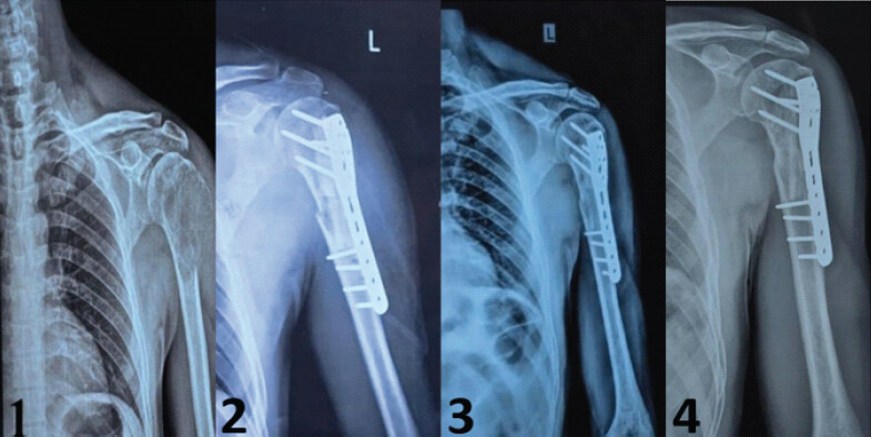 Figure 1: Radiographic findings. (1) Initial X-ray, (2) immediate post-operative, (3) after 1.5 years, (4) after 2 years.