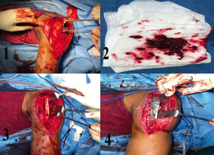 Figure 2: (1) Tumor identified, (2) curettage performed with high-speed burr, (3) pacing fibular strut graft, (4) augmenting with proximal humerus internal locking system plate.