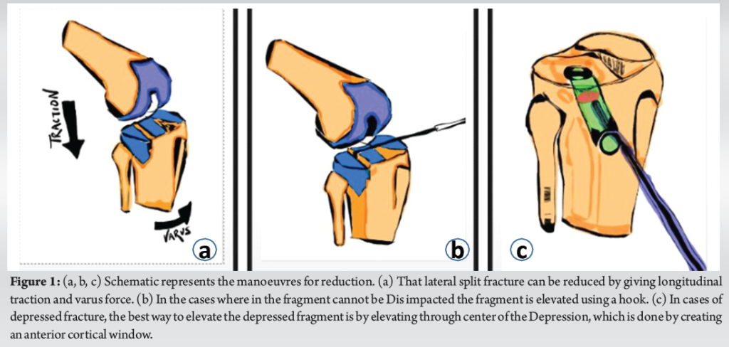 Arthroscopic Assisted Reduction and Fixation in Tibial Plateau ...