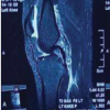 All-Inside Anterior Cruciate Ligament Reconstruction: A Minimally Invasive Bone Preserving Approach with Promising Functional Outcomes