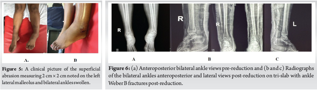 A Case Series on the Devastating Simultaneous Bilateral Fracture of ...
