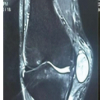 Angiofibroma of Knee Masquerading as Ganglion Cyst – A Rare Case Report