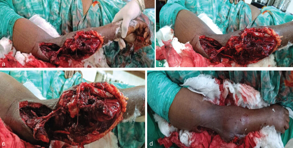 Figure 1: (a, b, c, d) Clinical photograph at presentation.