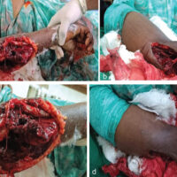 Figure 1: (a, b, c, d) Clinical photograph at presentation.