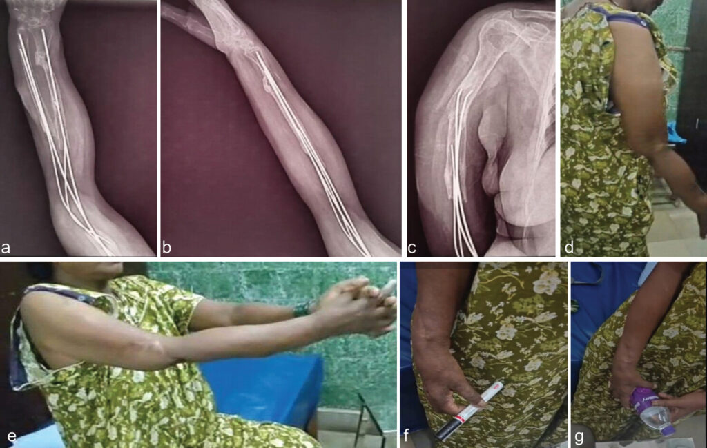 Figure 10: (a, b, c, d, e, f, g) Radiograph and clinical photographs at 8-month follow-up.