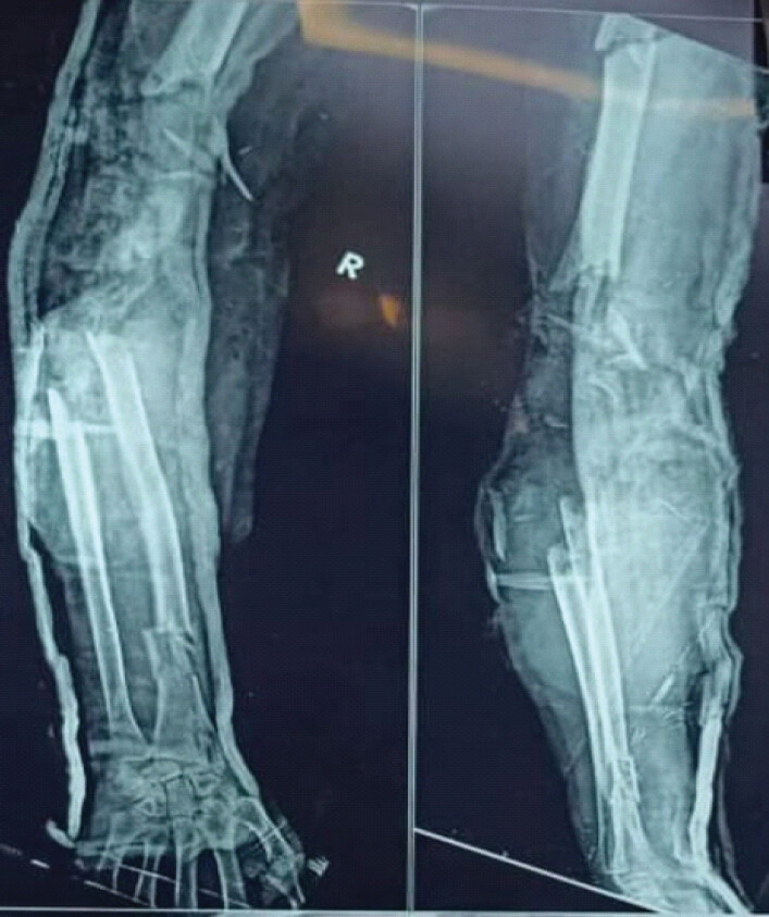 Figure 2: (a and b) Pre-operative radiograph showing fracture pattern.