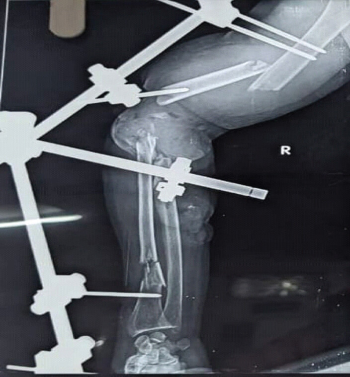 Figure 3: Radiograph after external fixation.