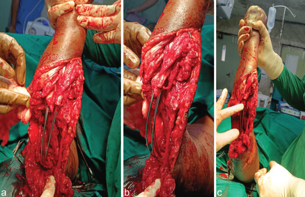 Figure 4: (a, b, c) Intraoperative radiograph showing spanning titanium elastic nailing system fixation.