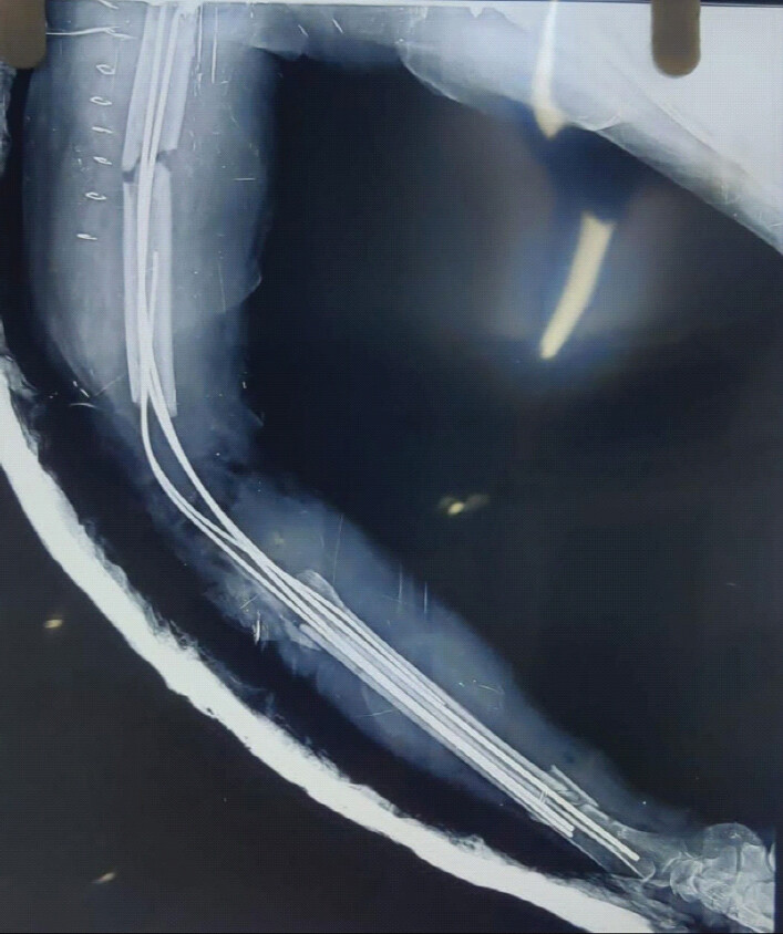 Figure 5: Post-operative radiograph showing spanning titanium elastic nailing system fixation.