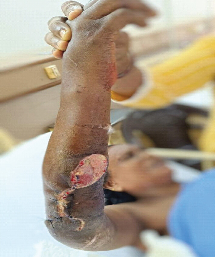Figure 6: Clinical photograph showing post-operative spanning titanium elastic nailing system fixation.