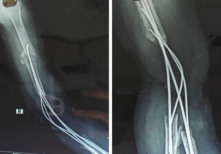 Figure 8: (a and b) Radiograph at 3 months.