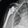 Strength Recovery with Lateralized Reverse Total Shoulder Arthroplasty Combined with Pectoralis Major Transfer for Rotator Cuff Arthropathy with Internal Rotational Deficiency: A Case Report