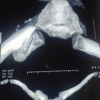 Surgical Treatment of a Non-union of Medial End Clavicle Fracture with Dual Plating and its Clinical Outcome – A Case Report
