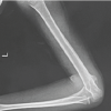 A Case Report: Post-traumatic Windswept Deformity of the Elbow – Rare but Possible