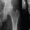 Bilateral Global Pincer-Type Femoroacetabular Impingement with CAM Lesions: Arthroscopic Management Using a Peripheral First Approach