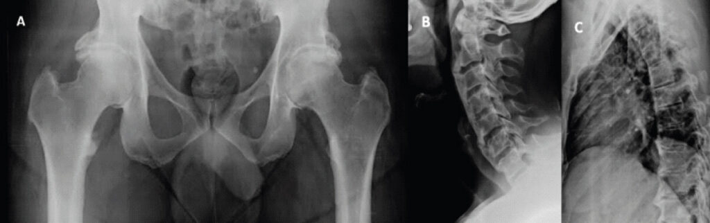 Figure 1: (a) Pre-operative X-ray of bilateral hips showing global pincer and CAM lesions. X-ray (b) thoracic and (c) cervical spine showing fused vertebrae.