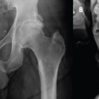 Figure 1: (a) Pre-operative X-ray of bilateral hips showing global pincer and CAM lesions. X-ray (b) thoracic and (c) cervical spine showing fused vertebrae.