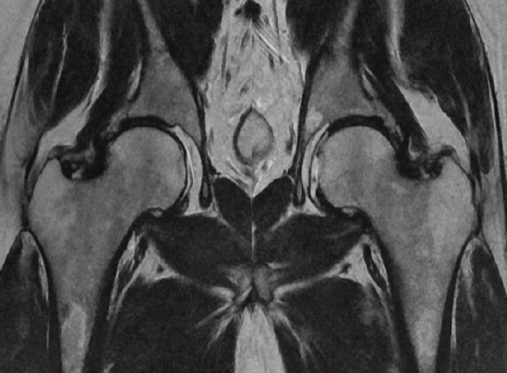 Figure 2: Pre-operative magnetic resonance imaging showing bilateral pincer lesions.