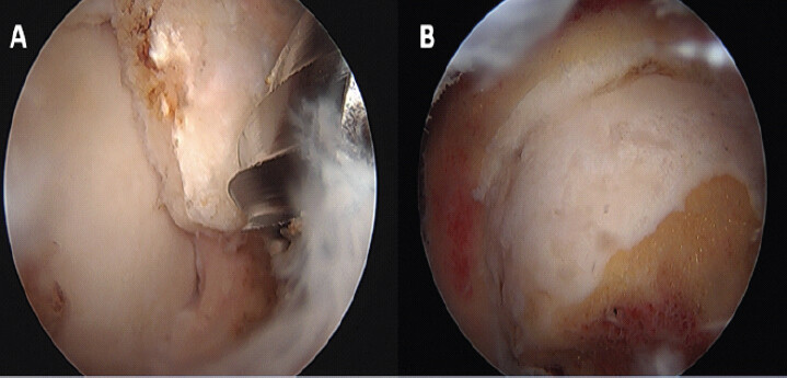 Figure 3: (a) Intraoperative images showing the large pincer lesion. (b) Intraoperative images after the pincer and CAM osteoplasty.