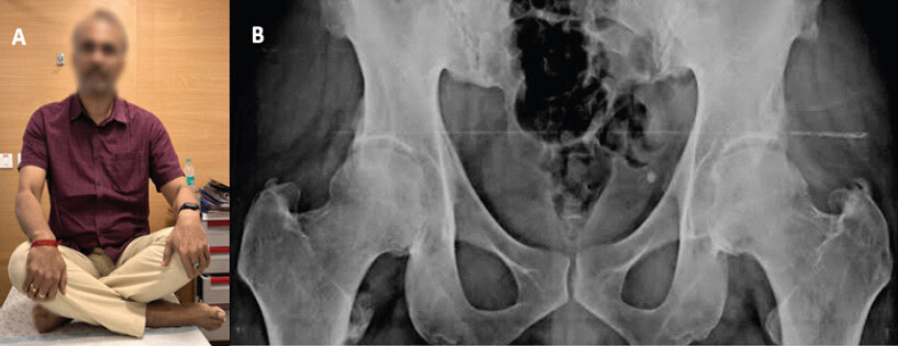 Figure 4: (a) Examination at 6 weeks post-operative after left hip (2nd Hip) surgery showing full and painless range of motion of bilateral hips and (b) post-operative X-ray showing trimmed pincer and CAM lesions.