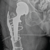 A Novel Approach to Atypical Periprosthetic Femoral Fractures with Stem Breakage: A Case Report