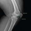 A Rare Presentation of Idiopathic Medial Patellar Instability: Case Report and Review of the Literature
