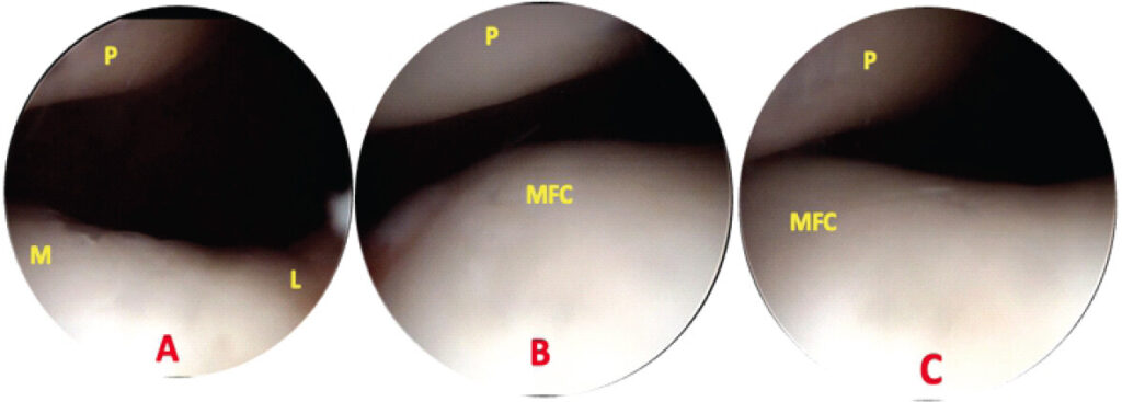 Figure 3: Pre-release of medial band – medial maltracking patella, (a, b, c) 15/30/45° of knee flexion.