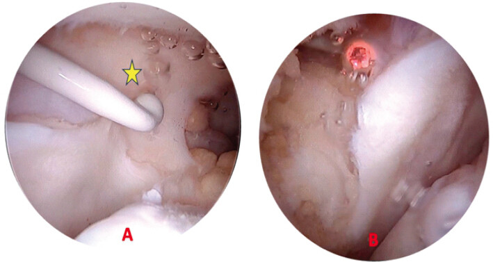 Figure 4: (a and b) Release of the medial band.