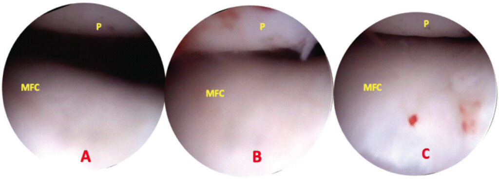 Figure 5: Post-release – centralized patella, (a, b, c) 15/30/45° of knee flexion.