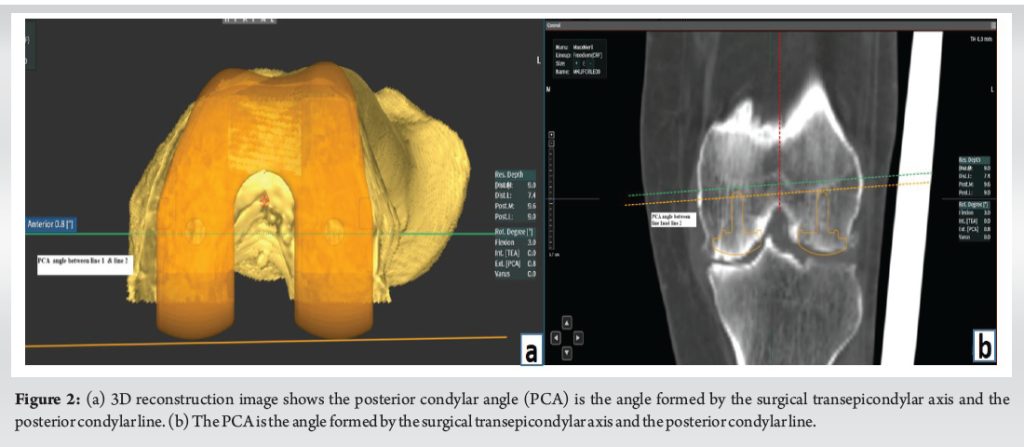 The Role of Computed Tomography in Achieving True External Rotation in ...
