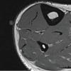 Tibialis Anterior Muscle Herniation Managed with Ovine Extracellular Matrix Patch: Case Report