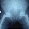 The Development of Metabolic Bone Failure as the Principal Manifestation of Undiagnosed Primary Hyperparathyroidism: A Rare Instance of Bilateral Femoral Neck Fractures