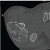 Intertrochanteric Fracture Secondary to Solitary Osteochondroma: A Case Report and Literature Review
