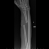 Escherichia hermannii: A Rare Pathogen in Implant-Associated Infection Following a Type III C Open Distal Radius Fracture – A Case Report