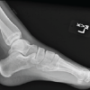A Rare Pediatric Cause of Lateral Foot Pain: Symptomatic Os Vesalianum Pedis Requiring Excision and Peroneus Brevis Repair