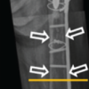 A Case Report of a Symptomatic Atrophy and Osteonecrosis of the Femoral Diaphysis In-duced by Internal Plate Fixation of a Periprosthetic Fracture
