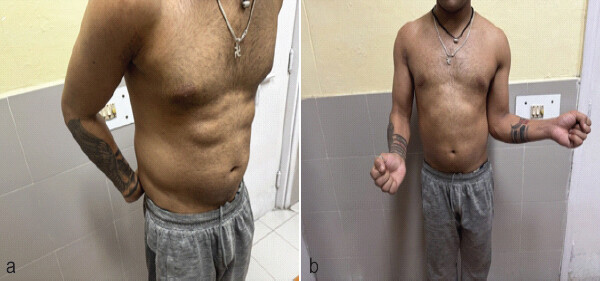 Figure 1: (a and b) Clinical pictures demonstrating severe restriction of rotation, with internal rotation limited to 20° and no external rotation of the right shoulder.