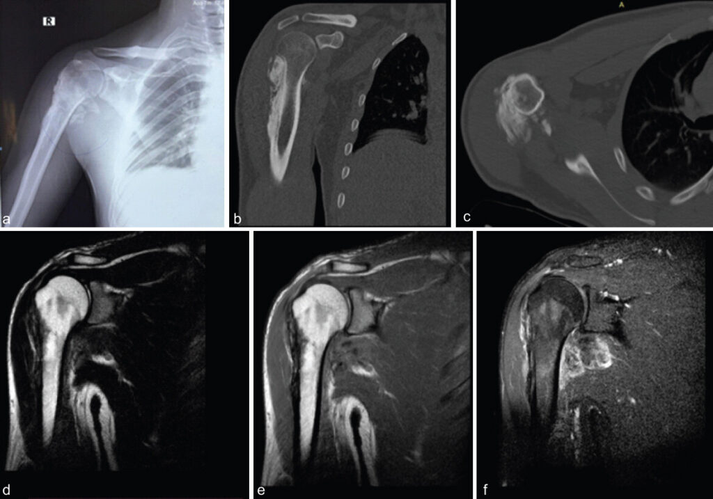 Figure 2: (a) Radiograph right shoulder joint and upper humerus showing irregular cortical thickening and periosteal reaction, with exostosis and soft-tissue calcification surrounding the right proximal humerus. (b) Non-contrast computed tomography (CT) scan right shoulder coronal reformatted image demonstrates periosteal thickening with soft-tissue calcification in Infraspinatus and subscapularis tendons. (c) Non-contrast CT scan right shoulder axial reformatted image confirms periosteal thickening with soft-tissue calcification in Infraspinatous and subscapularis tendons. (d) Dual T2 magnetic resonance imaging (MRI) image elicits moderate periosteal thickening with normal marrow signal intensity and peripheral rim enhancement on post-contrast T1Gd images in the infraspinatus and subscapularis muscles surrounding the calcifications. (e) Proton density MRI sequence. (f) Coronal MRI sequence.
