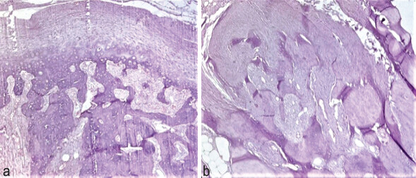Figure 3: (a) Hematoxylin and Eosin stain ×100 showing circumscription with mature lamellar bone in the periphery. (b) Hematoxylin and Eosin stain ×40 showing fibroblasts, osteoblasts, and osteoid separated by small-sized blood vessels.