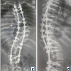 Fixation, Stabilization, Dynamic Stabilization, Fusion, and Reconstruction in Spine Surgery– Decoding Terminologies!