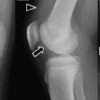 A Case of Fixation Using Poly-L-Lactic Acid Pins for Chronic Juvenile Massive Osteochondritis Dissecans of the Knee
