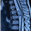 Osteochondroma Arising from Dorsal Pedicle Causing Compressive Myelopathy