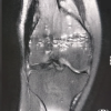 Post-traumatic Patellofemoral Ankylosis treated with Robotic Arm Assisted Patellofemoral Arthroplasty – A Case Report