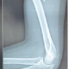 Retrograde Titanium Elastic Nailing for Diaphyseal Fractures of the Humerus in Children through a Single Central Entry Point: A Case Series with Review of Literature