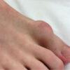 Hallux Mystery: A Rare Case of Fibro-Osseous Pseudotumor